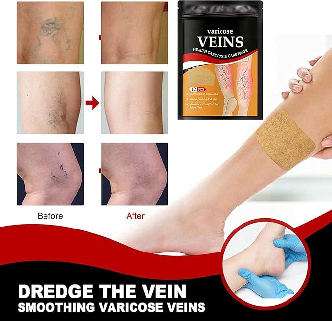 Varicose veins patches(BUY 1 GET 1 FREE)