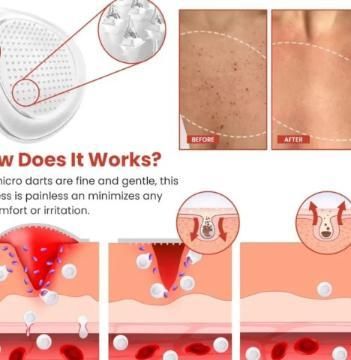 Skin Tag Remover Patch(BUY 1 GET 1 FREE)