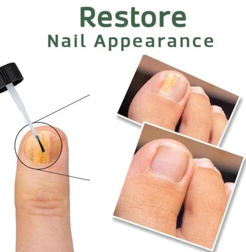 BeeVenom Nail Fungus Solution  (BUY 1 GET 1 FREE)