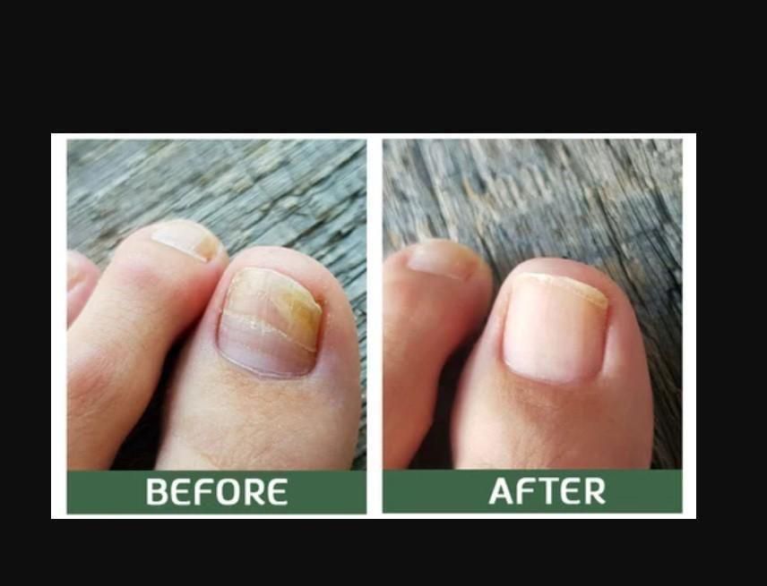 BeeVenom Nail Fungus Solution  (BUY 1 GET 1 FREE)