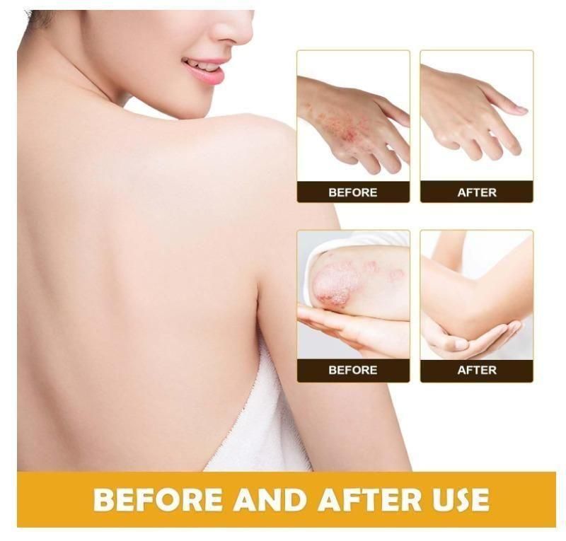 Bee Venom Psoriasis Treatment Cream 60gm (Pack Of 2)