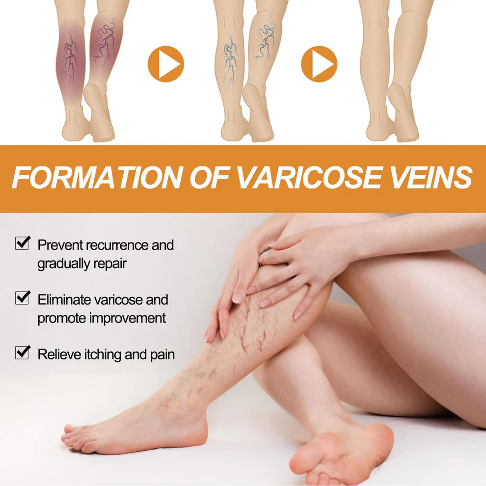 Varicose Veins Spray - Natural Herbal Formula for Fast Relief ( BUY 1 GET 1 FREE )