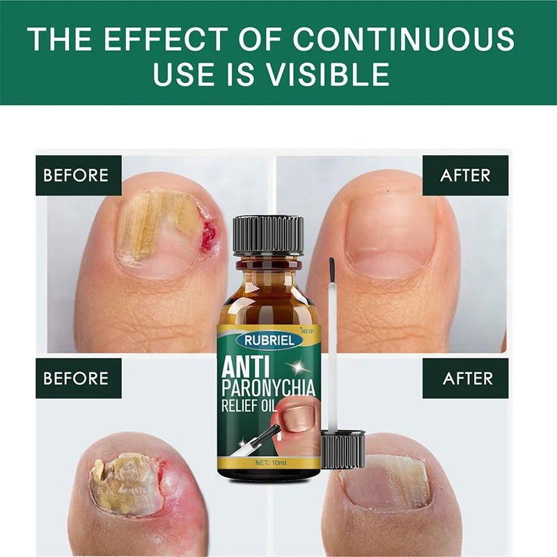 Anti Paronychia Relief Oil 🌿 - (Buy 1 Get 1 FREE🔥🔥)