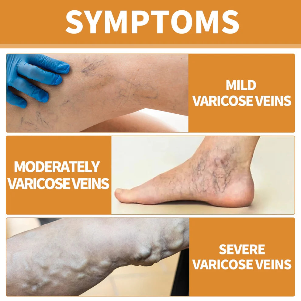 Varicose Veins Spray - Natural Herbal Formula for Fast Relief ( BUY 1 GET 1 FREE )