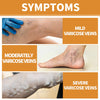 Varicose Veins Spray - Natural Herbal Formula for Fast Relief ( BUY 1 GET 1 FREE )