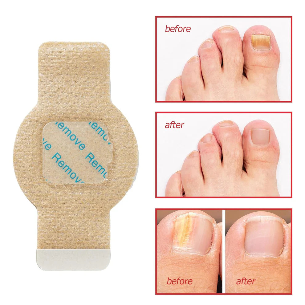 Fungus Nail Patches (BUY 1 GET 1 FREE)