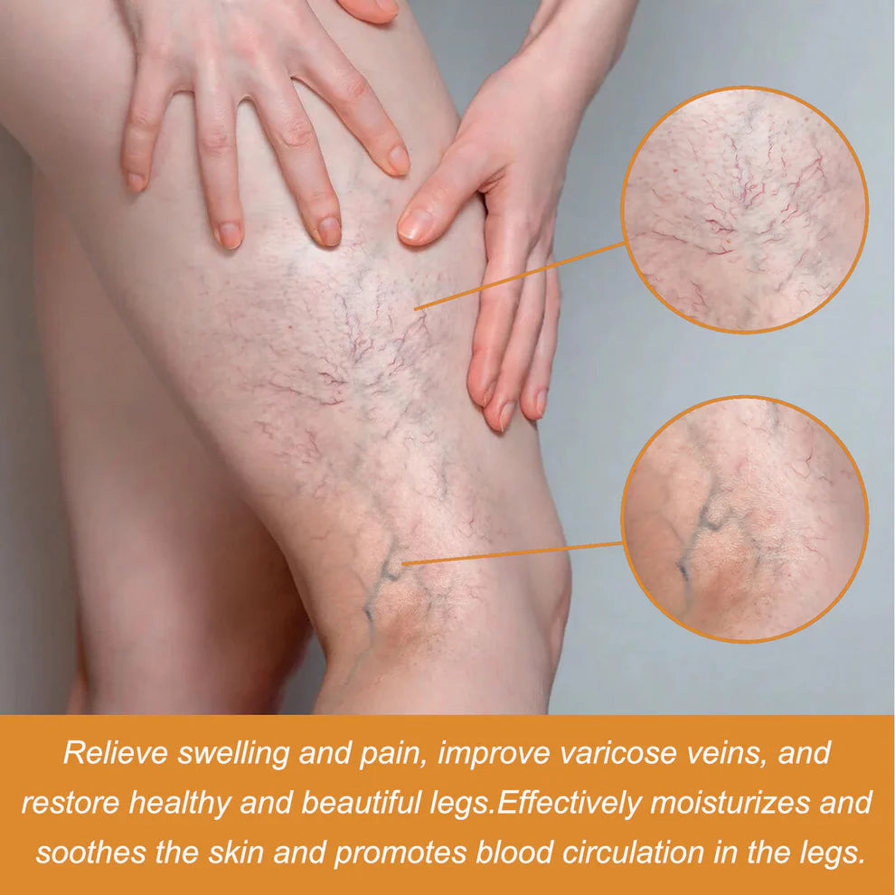 Varicose Veins Spray - Natural Herbal Formula for Fast Relief ( BUY 1 GET 1 FREE )